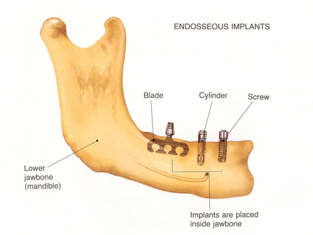 Implant Design