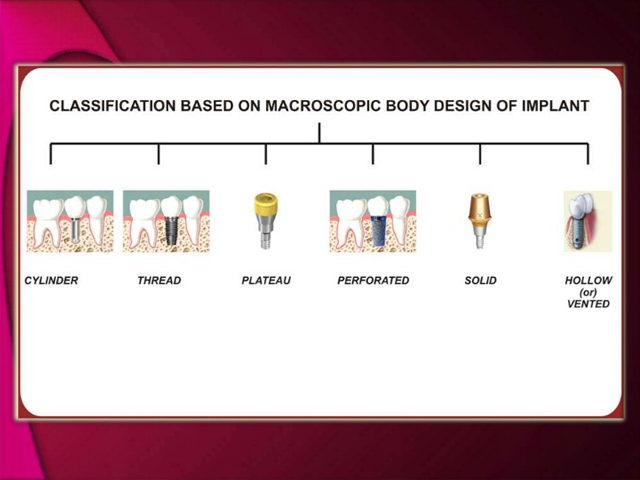 Implant Design