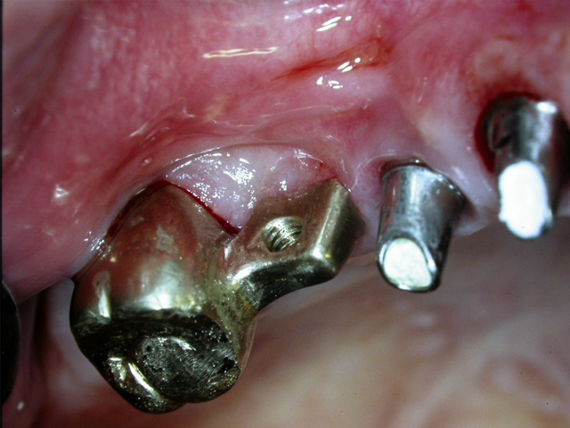 Implant Design